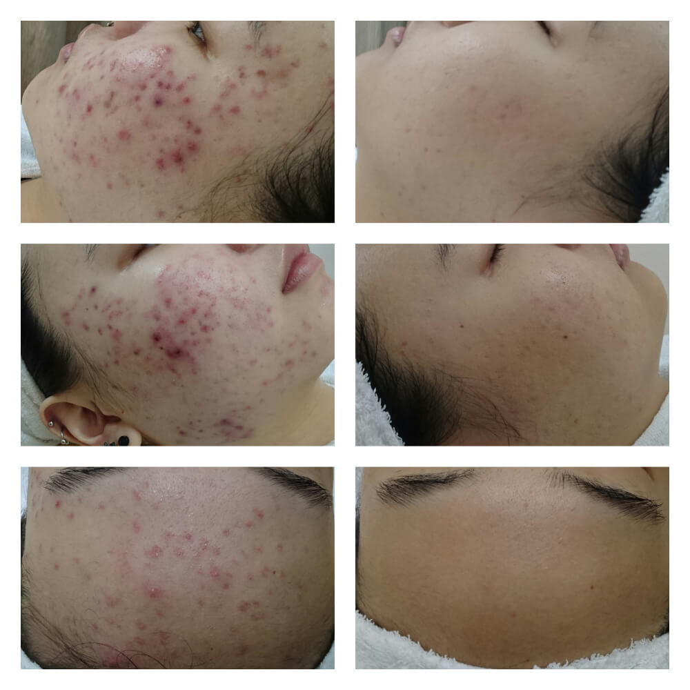 Before and after acne scar treatment