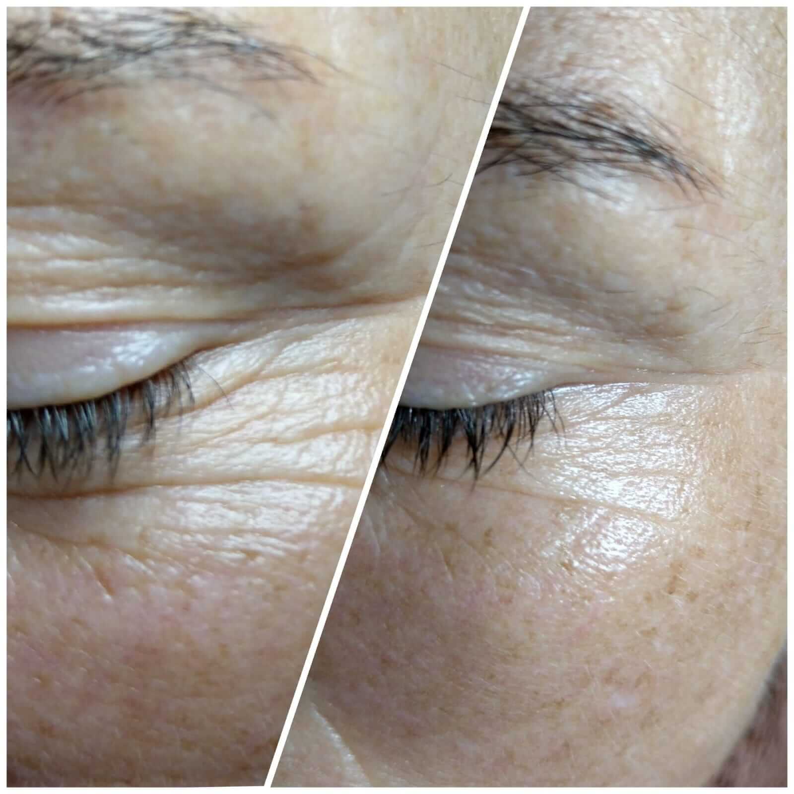 Before and after eye treatment
