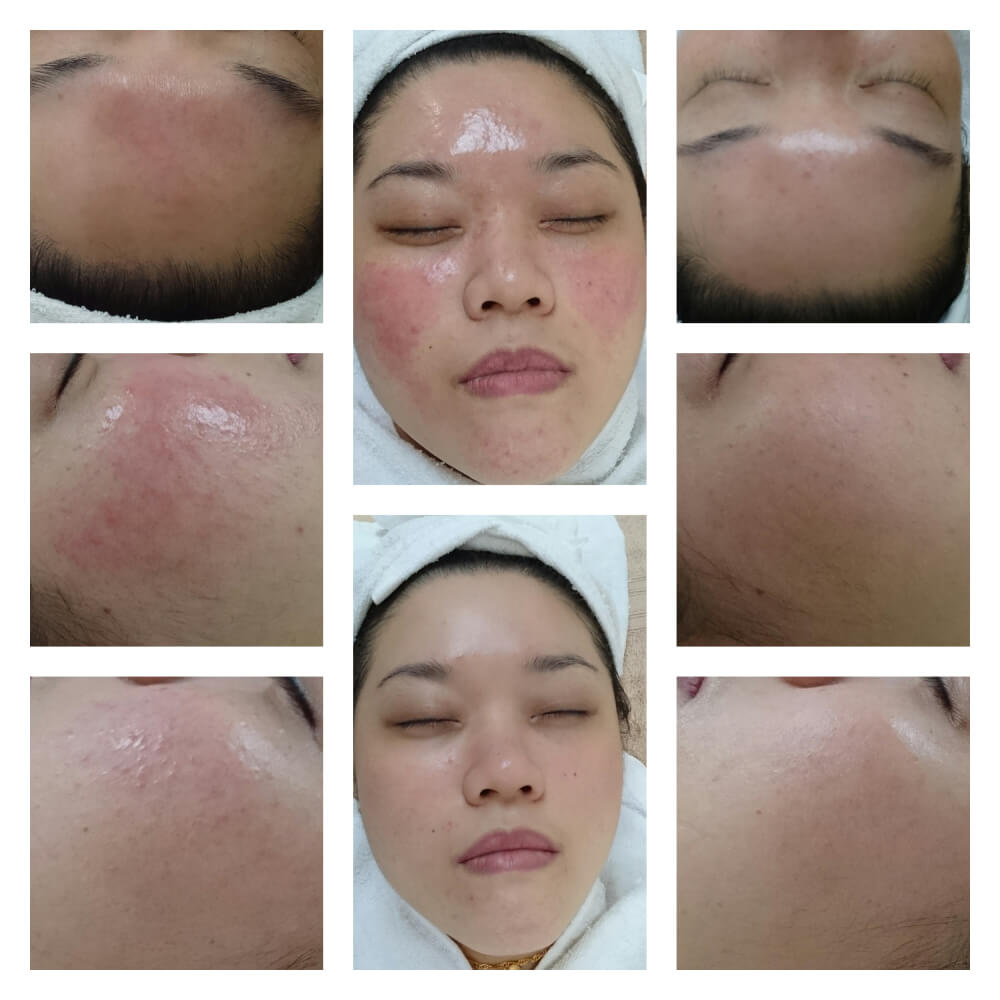 Different angles of the skin treatment on the face